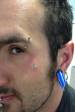 Eyebrow, antieyebrow anchor, 2.4mm lobe